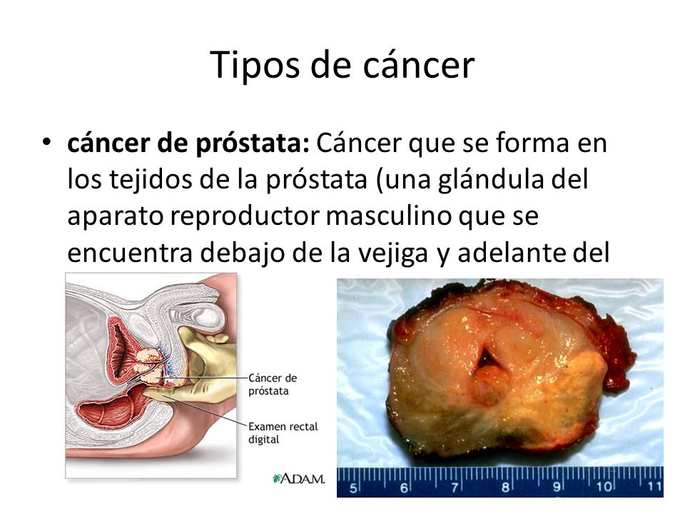 tipos de cancer del aparato reproductor masculino tipos de cancer del aparato reproductor masculino